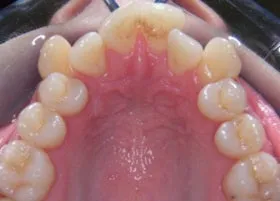 Before treatment