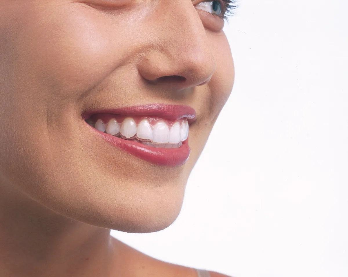 A close-up of teeth ready to receive a retainer